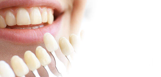 Tooth fillings