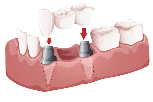 Bridge partial denture