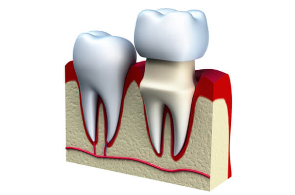 Dental Crown